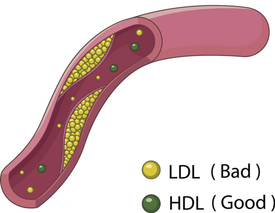 Nguyên nhân tăng cholesterol LDL
