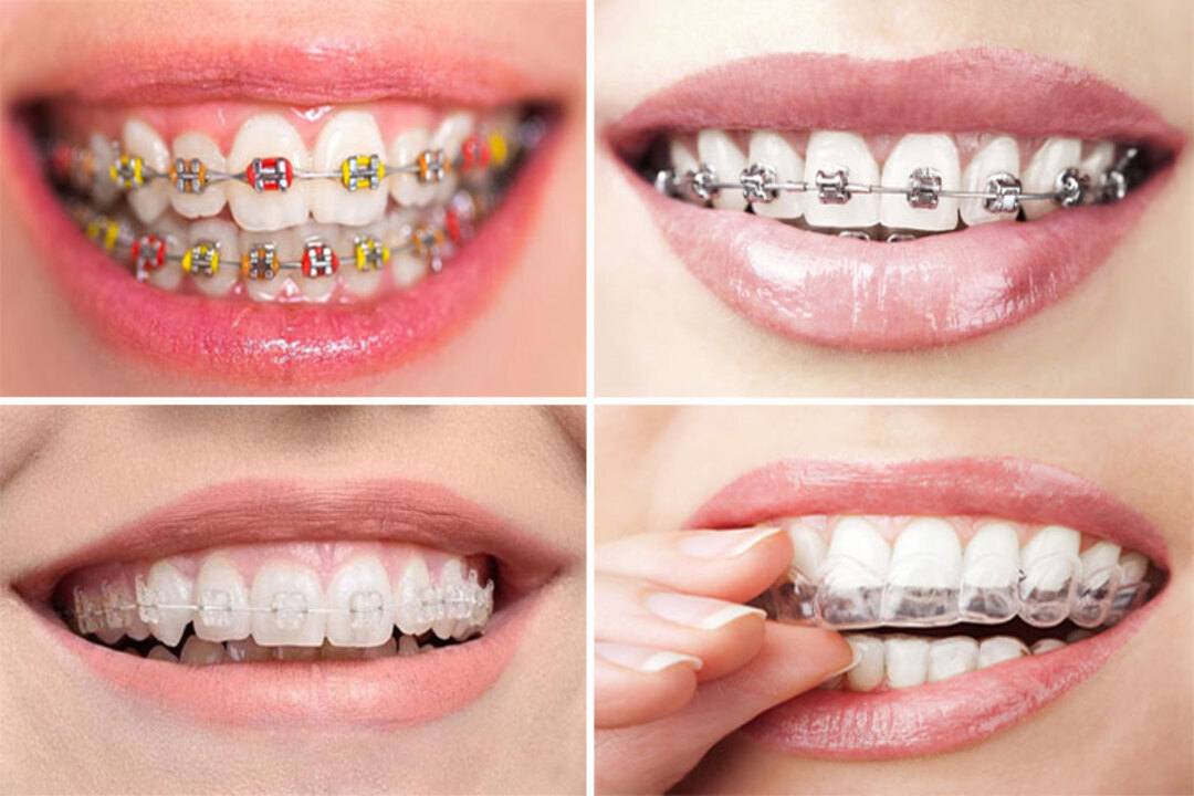 Những phương pháp niềng răng thông dụng nhất