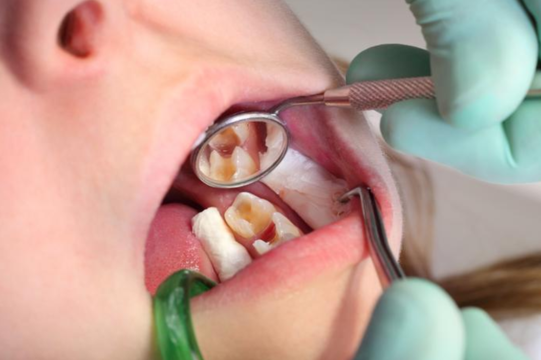 Quy trình trám răng