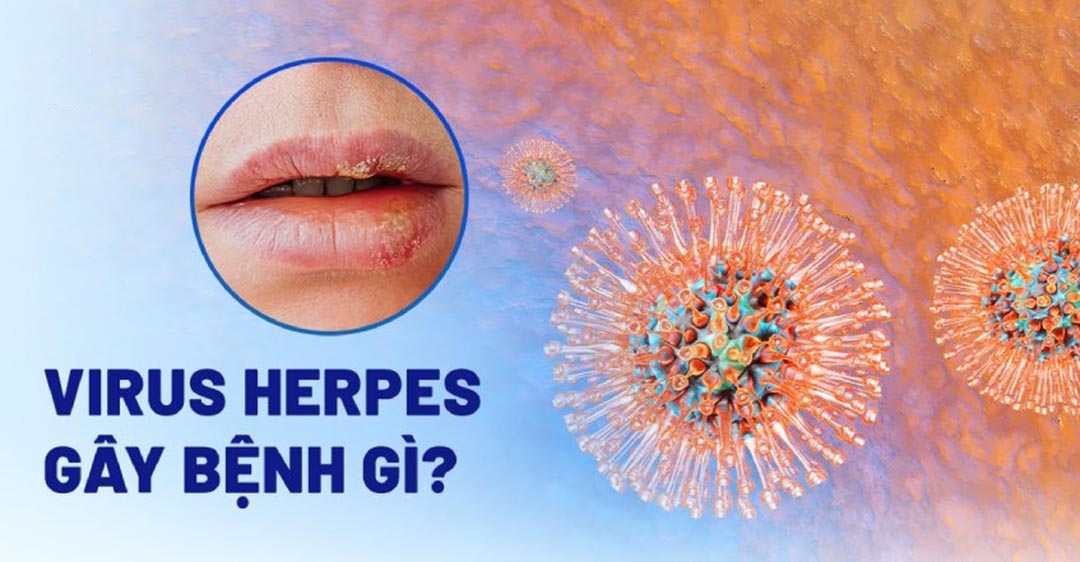 virus Herpes là gì