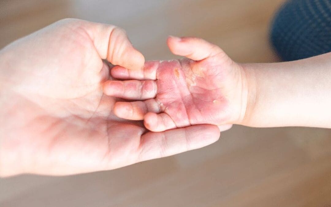 trẻ bị bỏng hơi nồi cơm điện